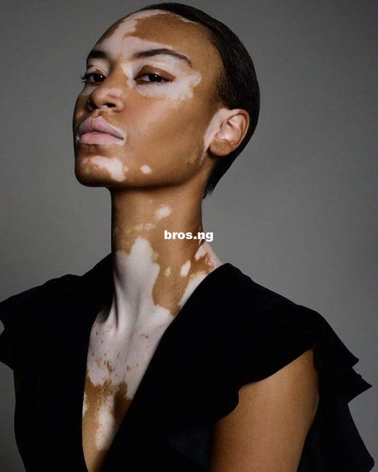 Skincare Tips for Nurturing Vitiligo